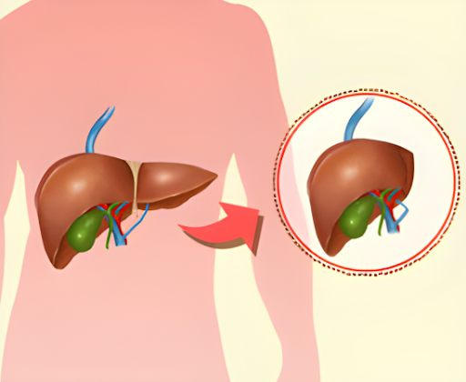 cadaveric-liver-transplant